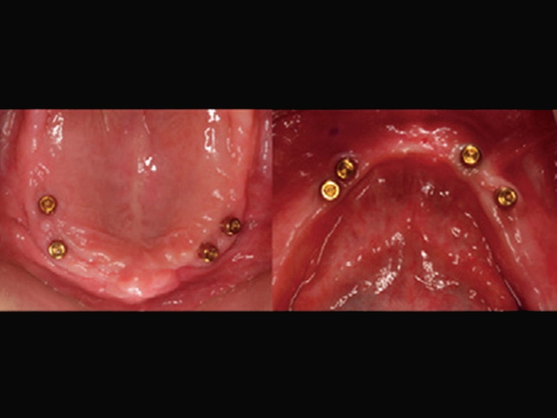 2. Setzen Sie das Implantat in den Knochen