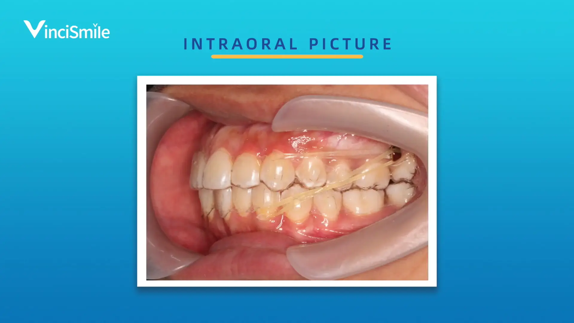 Arbeits tipps-Mini-Implantate